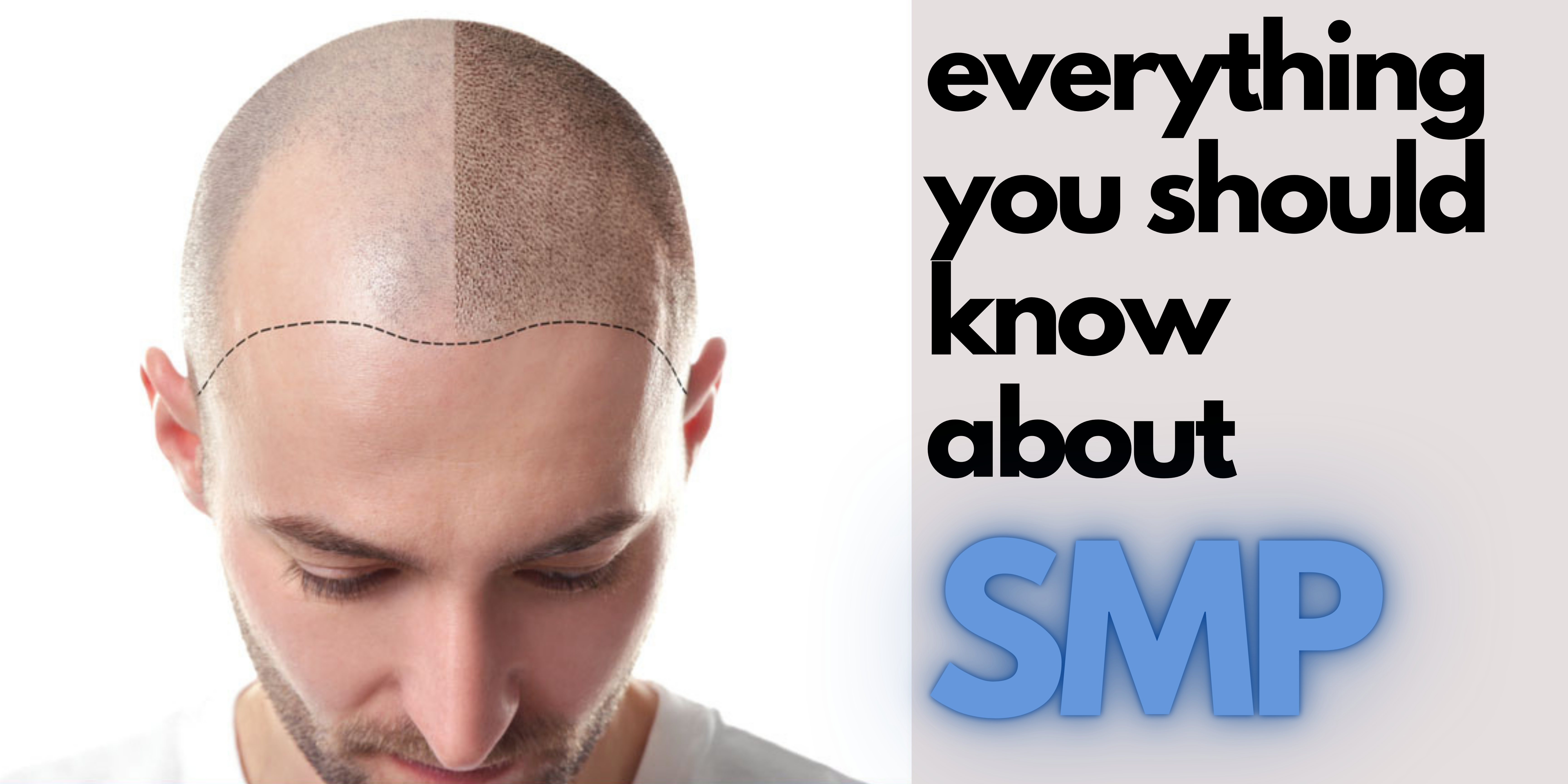 Everything About Scalp Micropigmentation